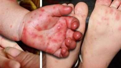 الصحة الماليزية تحذر من تفشي مرض حمى الأطفال HFMD بمستويات مقلقة