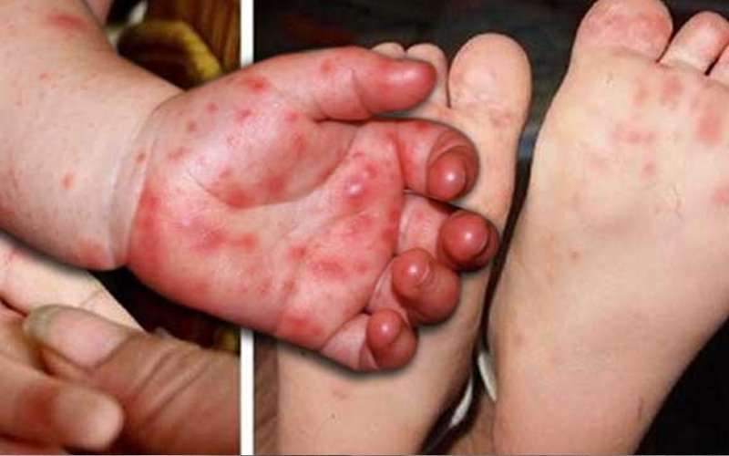 الصحة الماليزية تحذر من تفشي مرض حمى الأطفال HFMD بمستويات مقلقة